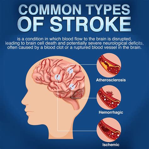 what disease are similar to a stroke